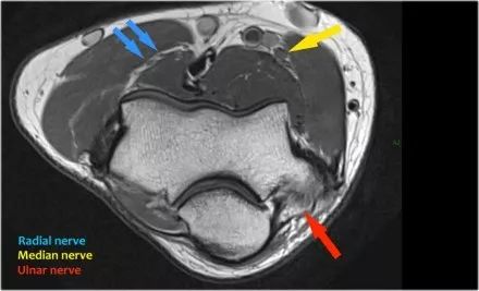 肘关节常见疾病的MRI影像图谱，赶快收藏！