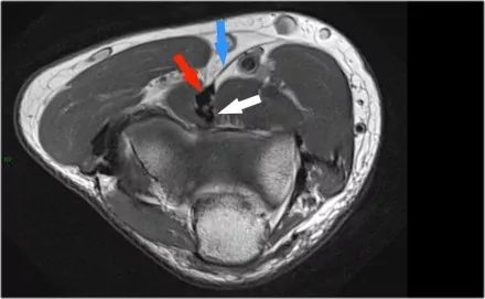 肘关节常见疾病的MRI影像图谱，赶快收藏！