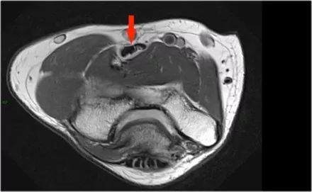 肘关节常见疾病的MRI影像图谱，赶快收藏！