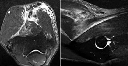 肘关节常见疾病的MRI影像图谱，赶快收藏！