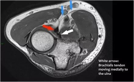 肘关节常见疾病的MRI影像图谱，赶快收藏！