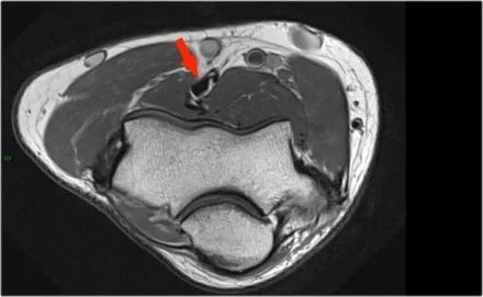 肘关节常见疾病的MRI影像图谱，赶快收藏！
