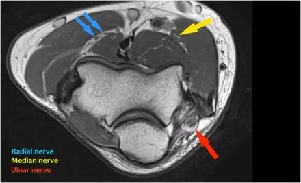 肘关节常见疾病的MRI影像图谱，赶快收藏！