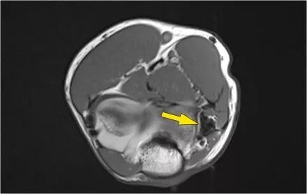 肘关节常见疾病的MRI影像图谱，赶快收藏！