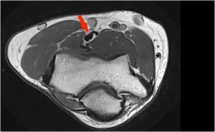 肘关节常见疾病的MRI影像图谱，赶快收藏！