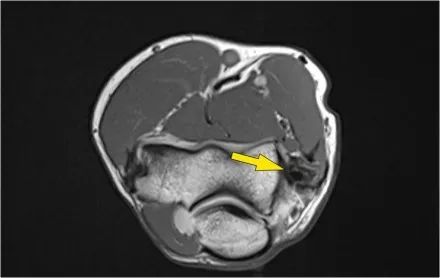 肘关节常见疾病的MRI影像图谱，赶快收藏！