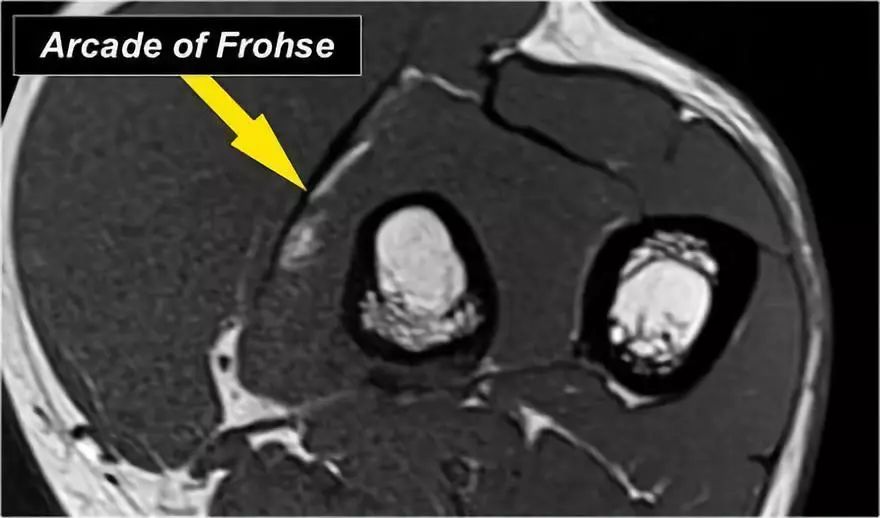 肘关节常见疾病的MRI影像图谱，赶快收藏！