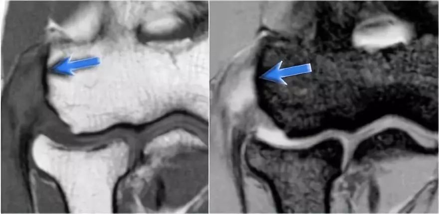 肘关节常见疾病的MRI影像图谱，赶快收藏！