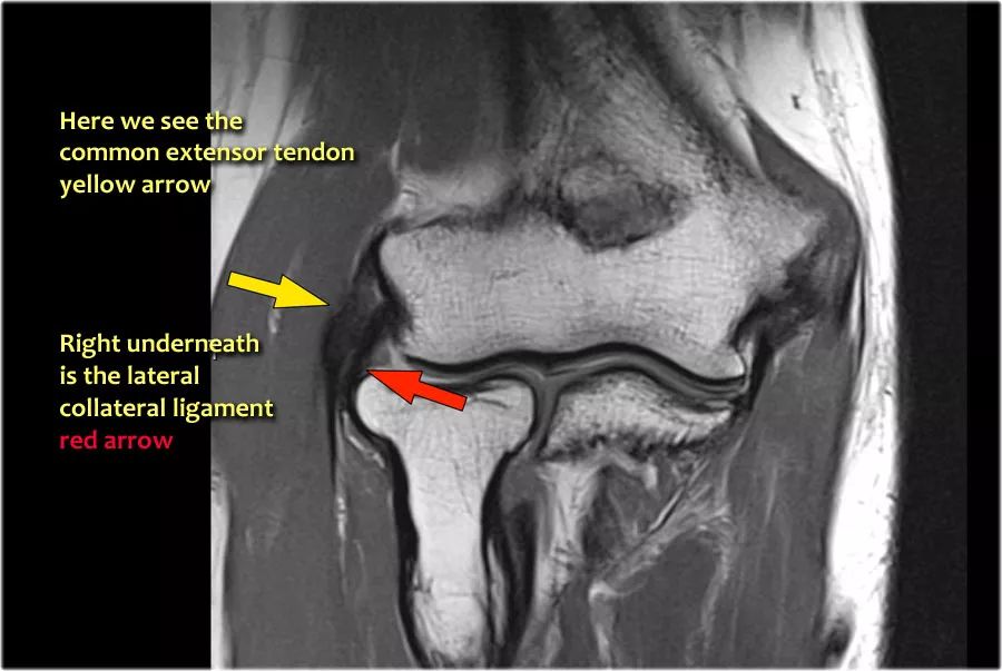 肘关节常见疾病的MRI影像图谱，赶快收藏！
