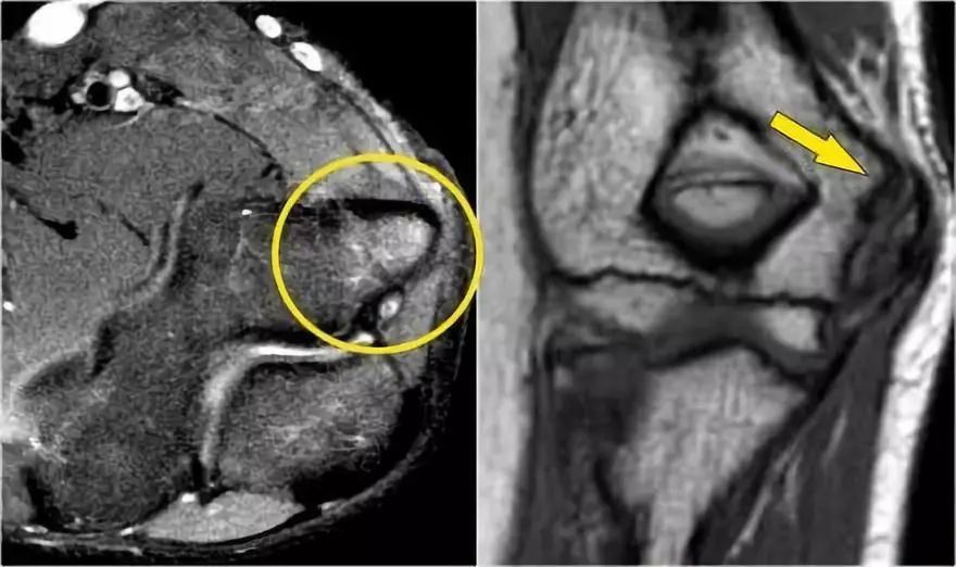肘关节常见疾病的MRI影像图谱，赶快收藏！