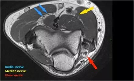 肘关节常见疾病的MRI影像图谱，赶快收藏！