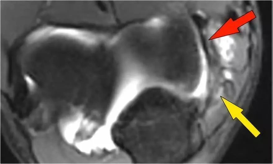 肘关节常见疾病的MRI影像图谱，赶快收藏！