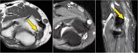肘关节常见疾病的MRI影像图谱，赶快收藏！