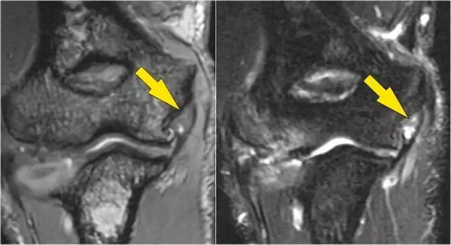 肘关节常见疾病的MRI影像图谱，赶快收藏！