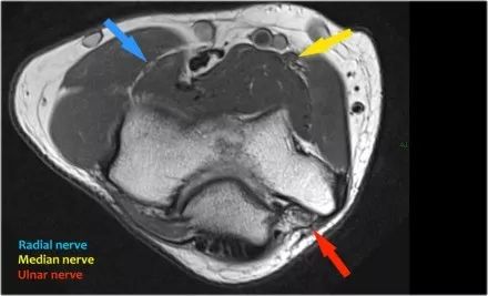 肘关节常见疾病的MRI影像图谱，赶快收藏！