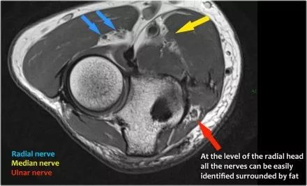 肘关节常见疾病的MRI影像图谱，赶快收藏！
