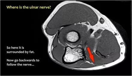 肘关节常见疾病的MRI影像图谱，赶快收藏！