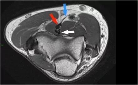 肘关节常见疾病的MRI影像图谱，赶快收藏！