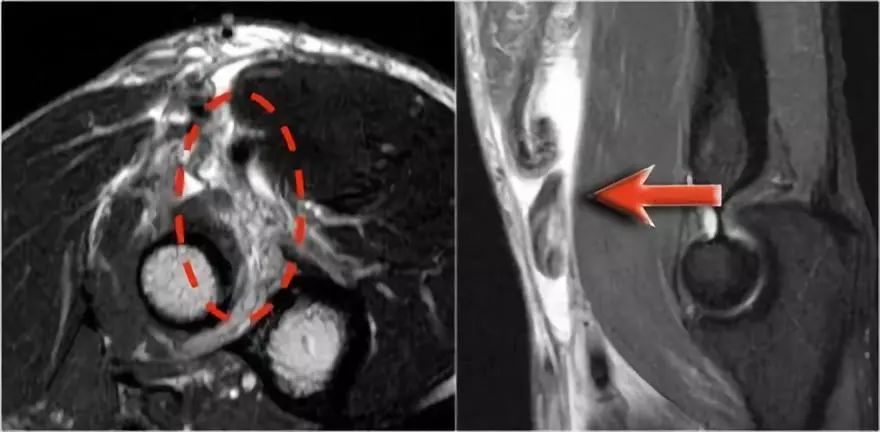 肘关节常见疾病的MRI影像图谱，赶快收藏！