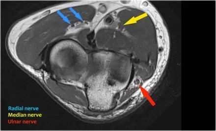 肘关节常见疾病的MRI影像图谱，赶快收藏！