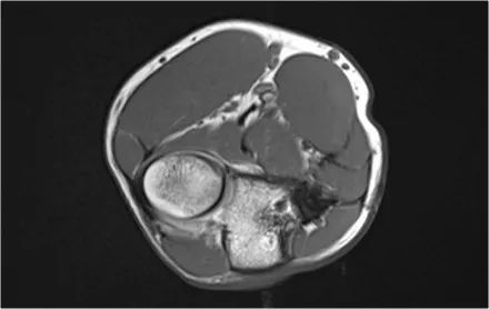 肘关节常见疾病的MRI影像图谱，赶快收藏！