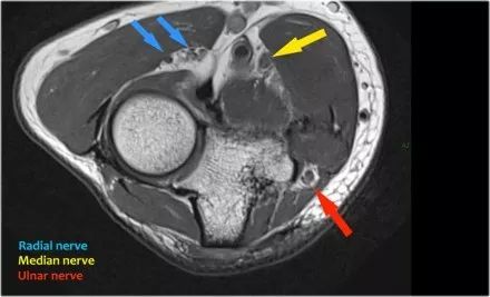 肘关节常见疾病的MRI影像图谱，赶快收藏！
