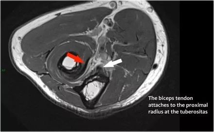 肘关节常见疾病的MRI影像图谱，赶快收藏！