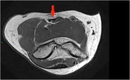 肘关节常见疾病的MRI影像图谱，赶快收藏！