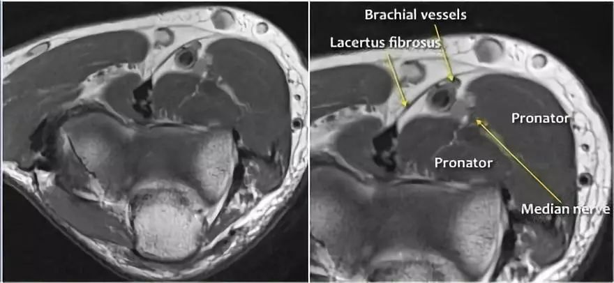 肘关节常见疾病的MRI影像图谱，赶快收藏！
