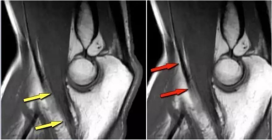 肘关节常见疾病的MRI影像图谱，赶快收藏！