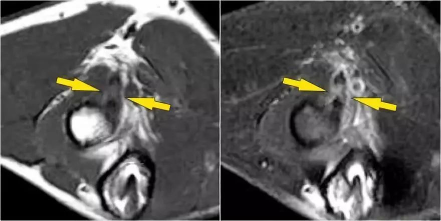 肘关节常见疾病的MRI影像图谱，赶快收藏！