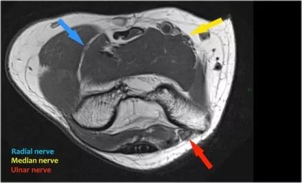 肘关节常见疾病的MRI影像图谱，赶快收藏！