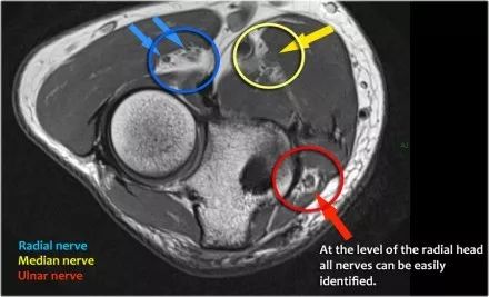 肘关节常见疾病的MRI影像图谱，赶快收藏！