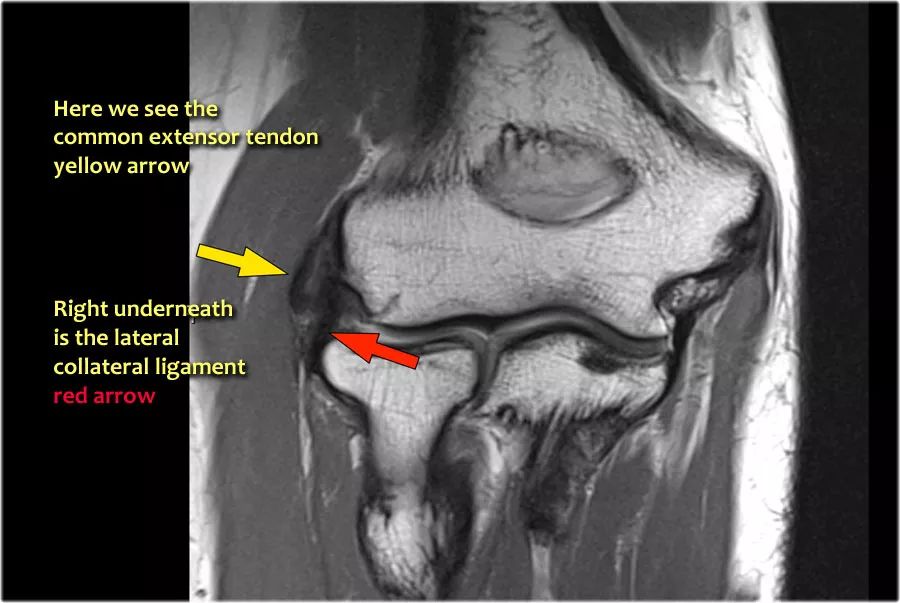 肘关节常见疾病的MRI影像图谱，赶快收藏！