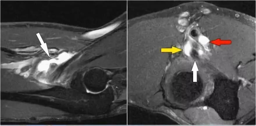 肘关节常见疾病的MRI影像图谱，赶快收藏！