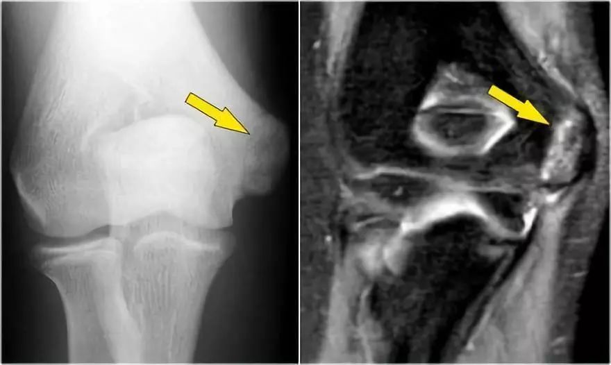 肘关节常见疾病的MRI影像图谱，赶快收藏！