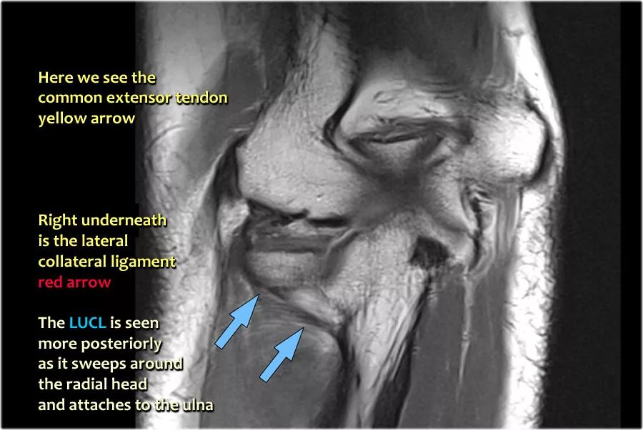 肘关节常见疾病的MRI影像图谱，赶快收藏！