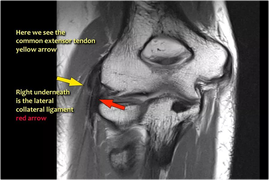 肘关节常见疾病的MRI影像图谱，赶快收藏！
