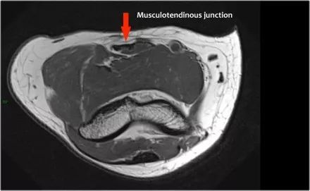 肘关节常见疾病的MRI影像图谱，赶快收藏！