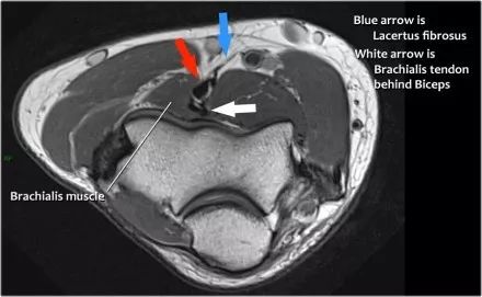 肘关节常见疾病的MRI影像图谱，赶快收藏！