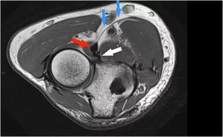 肘关节常见疾病的MRI影像图谱，赶快收藏！