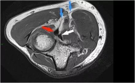 肘关节常见疾病的MRI影像图谱，赶快收藏！