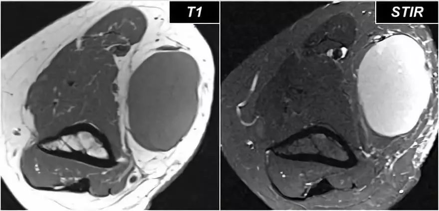 肘关节常见疾病的MRI影像图谱，赶快收藏！