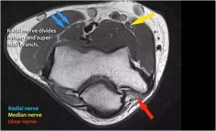 肘关节常见疾病的MRI影像图谱，赶快收藏！