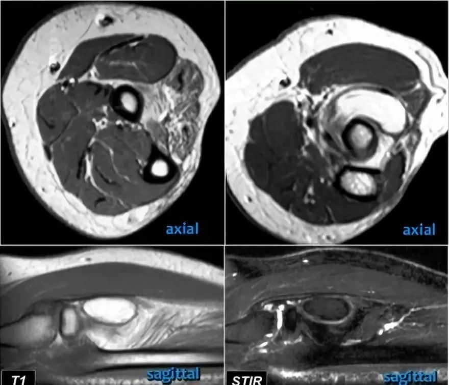 肘关节常见疾病的MRI影像图谱，赶快收藏！