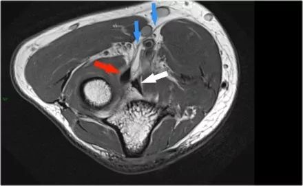 肘关节常见疾病的MRI影像图谱，赶快收藏！