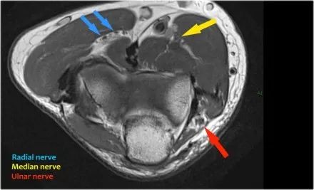 肘关节常见疾病的MRI影像图谱，赶快收藏！