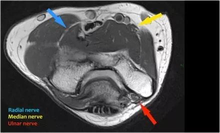 肘关节常见疾病的MRI影像图谱，赶快收藏！