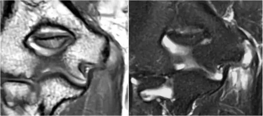 肘关节常见疾病的MRI影像图谱，赶快收藏！