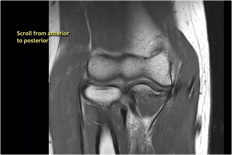 肘关节常见疾病的MRI影像图谱，赶快收藏！